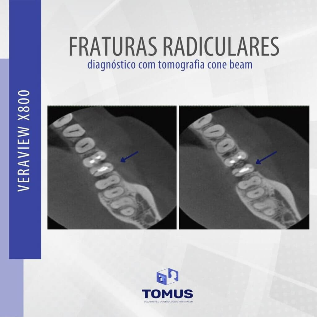 fraturas-radiculares